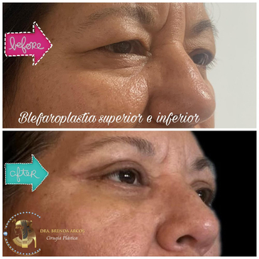 Slider image (5) Dra. Brenda Arcos Vera Cirugia Plastica